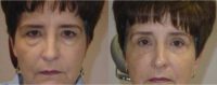 Upper and lower eyelid blepharoplasty (eyelid lift surgery)