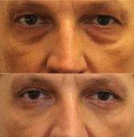 Upper and lower blepharoplasty in male