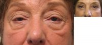 Upper eyelid ptosis repair and lower eyelid blepharoplasty and midface lift