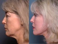 Upper & Lower Eyelid Surgery, Facelift & Brow Lift