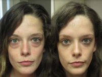 Woman treated with Eye Bags Treatment