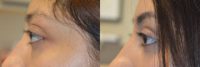 Young beautiful woman with Genetic Bulging Eyes underwent Scarless Cosmetic Orbital Decompression