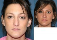 Young woman with rhinoplasty (nose surgery)