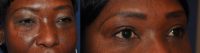 Blepharoplasty (Upper and Lower eyelids)