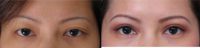 25-34 year old woman treated with Asian Eyelid Surgery