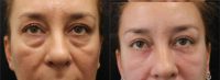 Lower Blepharoplasty combined with CO2 Laser Resurfacing