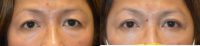 Asian Upper Blepharoplasty (Double Eyelid Surgery)