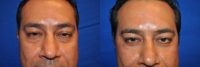 43 Year Old Male treated with Lower Eyelid Surgery to remove Puffy Eye Bags