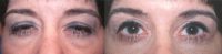 Lady with eyelid ptosis blocking her vision before ptosis correction surgery