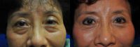 Asian Female eyelid surgery