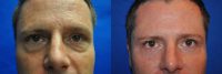 44 Year Old Male Lower Blepharoplasty to Eliminate Puffy Under-Eye Bags