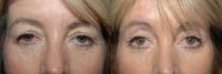 Uppe and Lower Eyelid Surgery