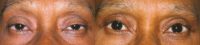 Drooping eyelid (ptosis) correction surgery in dark skin prone to scarring