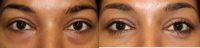 Eye Bag Removal Surgery in Darker Ethnic Skin Types Need Expert Treatment to Avoid Scarring