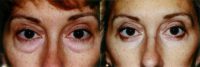 Blepharoplasty (lower eyelid surgery)