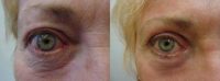 Woman treated with Eyelid Surgery