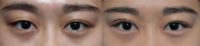 Non-incisional double eyelid surgery for one eyelid