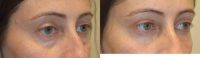 Upper and Lower Blepharoplasty Plus Upper Eyelid FIller Injection