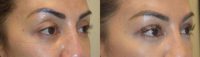 Upper Blepharoplasty Plus Upper Eyelid Filler Injection