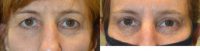 Upper Blepharoplasty for Hooded Upper Eyelids