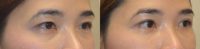 Young beautiful young Asian woman underwent Asian Upper Blepharoplasty (Double Eyelid Surgery)