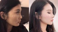 18-24 year old woman treated with Asian Rhinoplasty with DCF