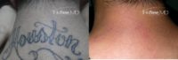 18-24 year old man treated with Laser Tattoo Removal (Marine)