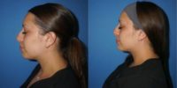 18-24 year old woman treated with Nonsurgical Nose Job, Dermal Fillers, Chin Filler
