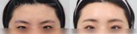 18-24 year old woman treated with Brow Lift