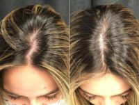 18-24 year old woman treated with PRP for Hair Loss
