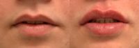18-24 year old woman treated with Lip Augmentation