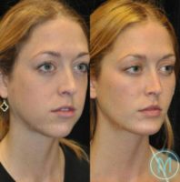 25 year old woman treated with Facial Fat Transfer