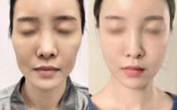 25-34 year old woman treated with Cheek Lift, Thread Lift