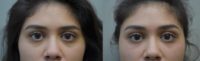 25-34 year old woman treated with Restylane Lyft