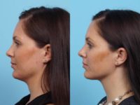 25-34 year old woman treated with Kybella