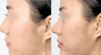 25-34 year old woman treated with Nose Thread Lift
