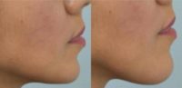 25-34 year old woman treated with Chin Filler