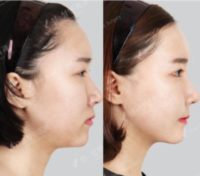 25-34 year old woman treated with Chin Surgery