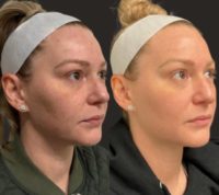 25-34 year old woman treated with Skin Rejuvenation, Laser Resurfacing