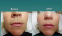 25-34 year old woman treated with Injectable Fillers, Lip Injections