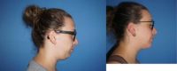 25-34 year old woman treated with Chin Liposuction, Chin Filler, Nonsurgical Neck Lift, Renuvion