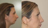 25-34 year old woman treated with Rhinoplasty and chin implant