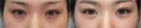 25-34 year old woman treated with Double Eyelid Surgery, Facial, Eyelid Surgery