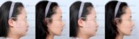 25-34 year old woman treated with Cheekbone Reduction, Genioplasty, Jaw Reduction, Asian Rhinoplasty, Facial Fat Transfer
