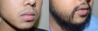 25-34 year old man treated with Beard Transplant