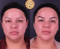 25-34 year old woman treated with FaceTite and Buccal Fat Pad Removal
