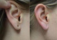25-34 year old woman treated with Earlobe Surgery