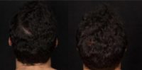 25-34 year old man treated with Hair Loss Treatment