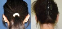 25-34 year old woman treated with Ear Surgery