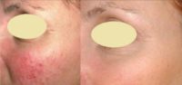 25-34 year old woman treated with Rosacea Treatment